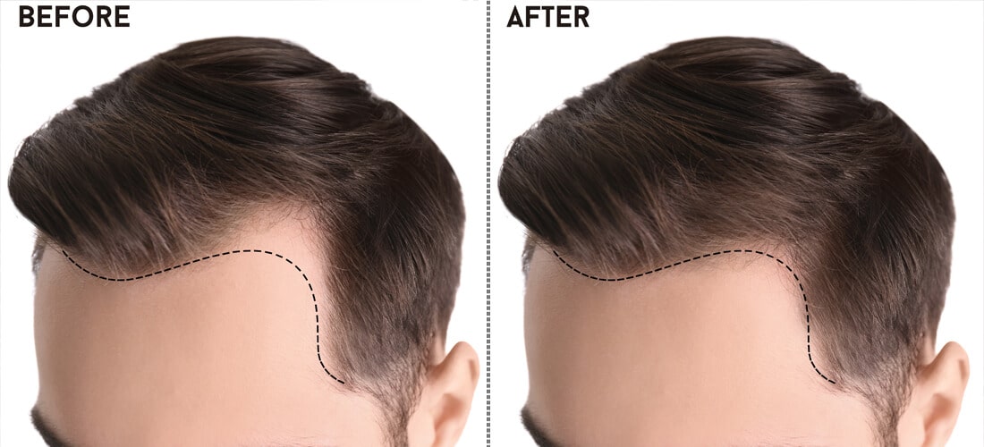 Unraveling Excellence: A Comprehensive Guide to Hair Transplant in Islamabad