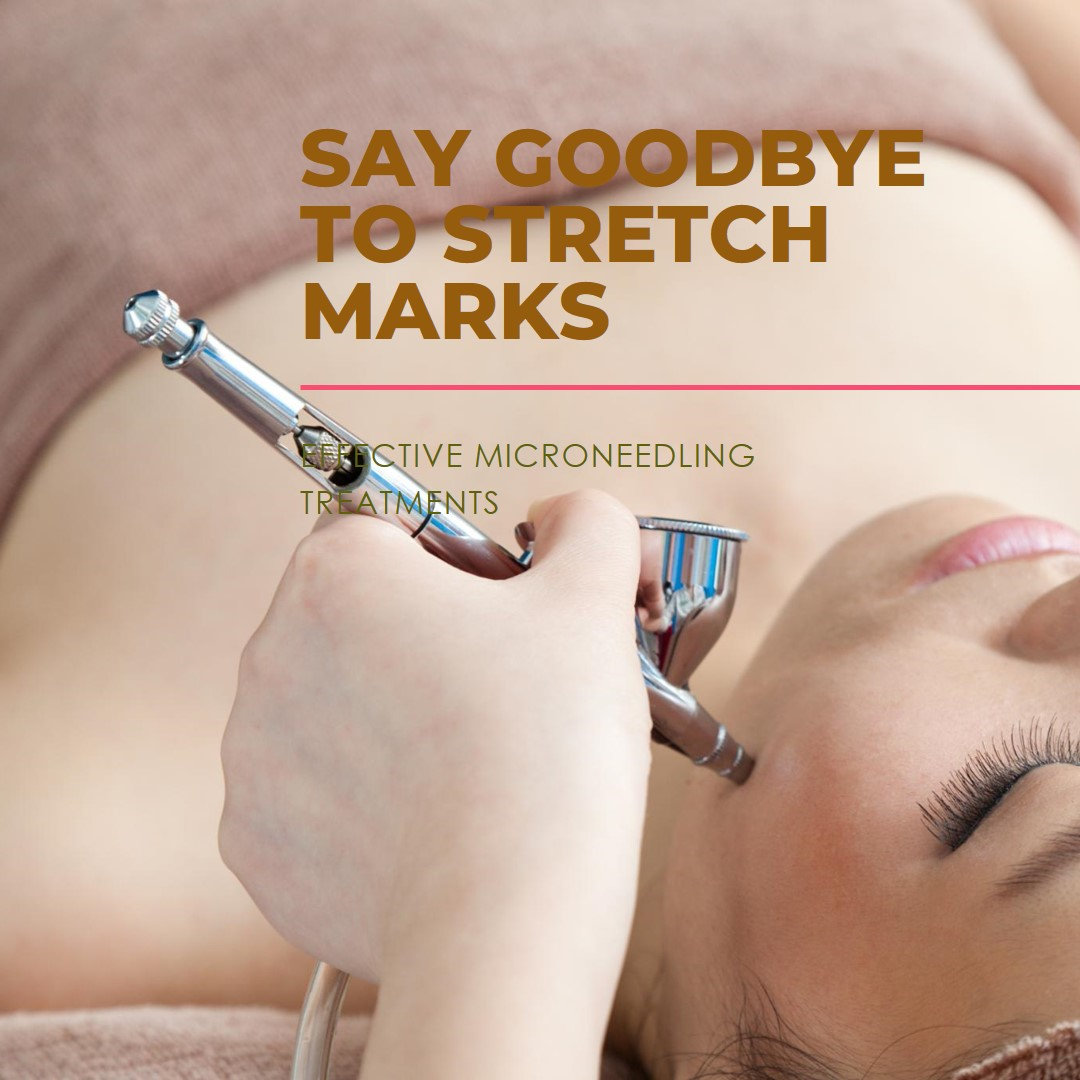 Effective Microneedling Treatments for Stretch Marks