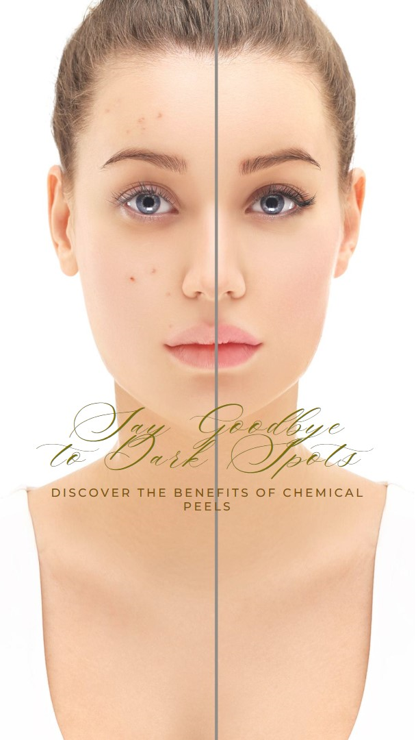 Benefits of Chemical Peels for Dark Spots
