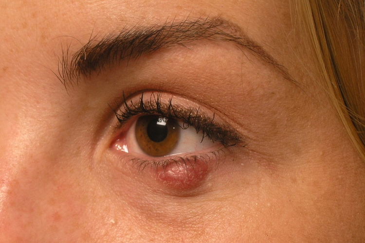 mole removal under eye
