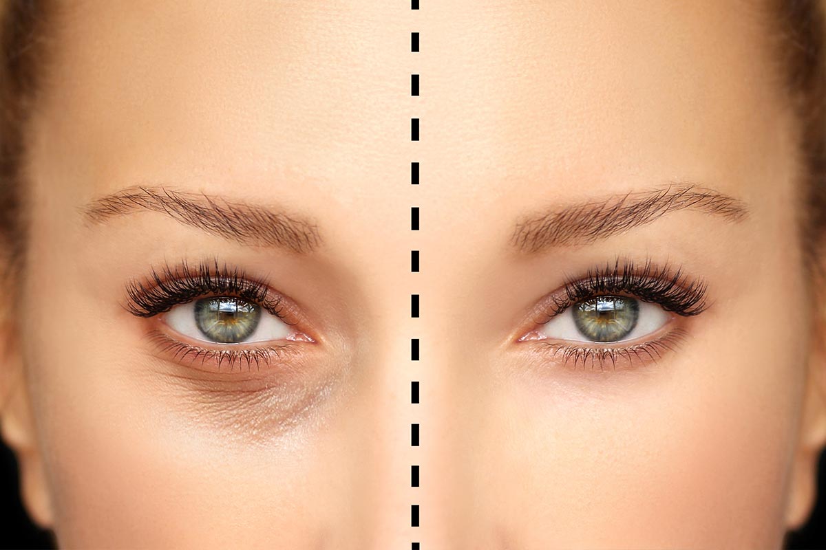 The Role of Support Garments in Blepharoplasty Recovery