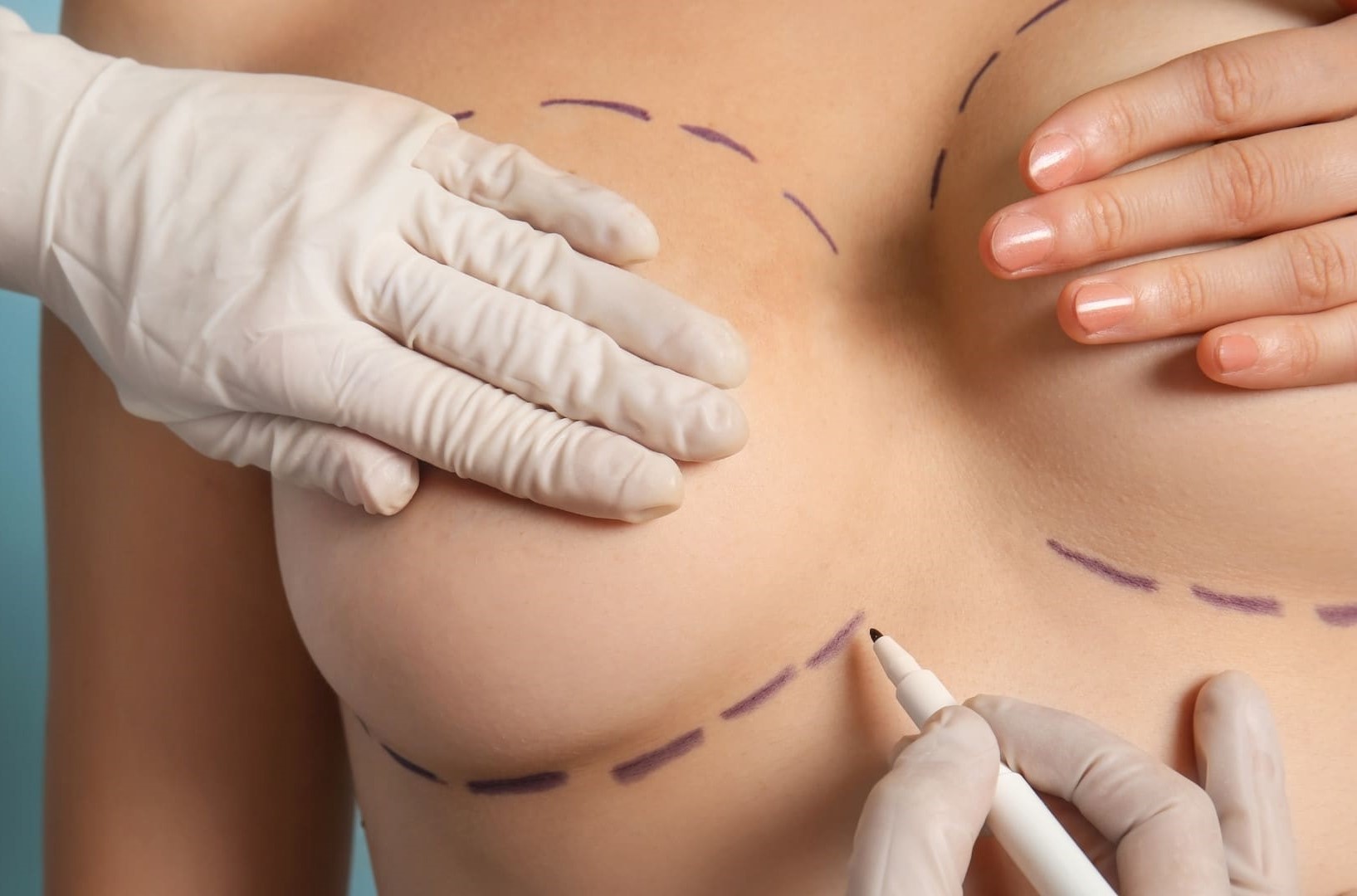 Breast Fat Transfer in Dubai