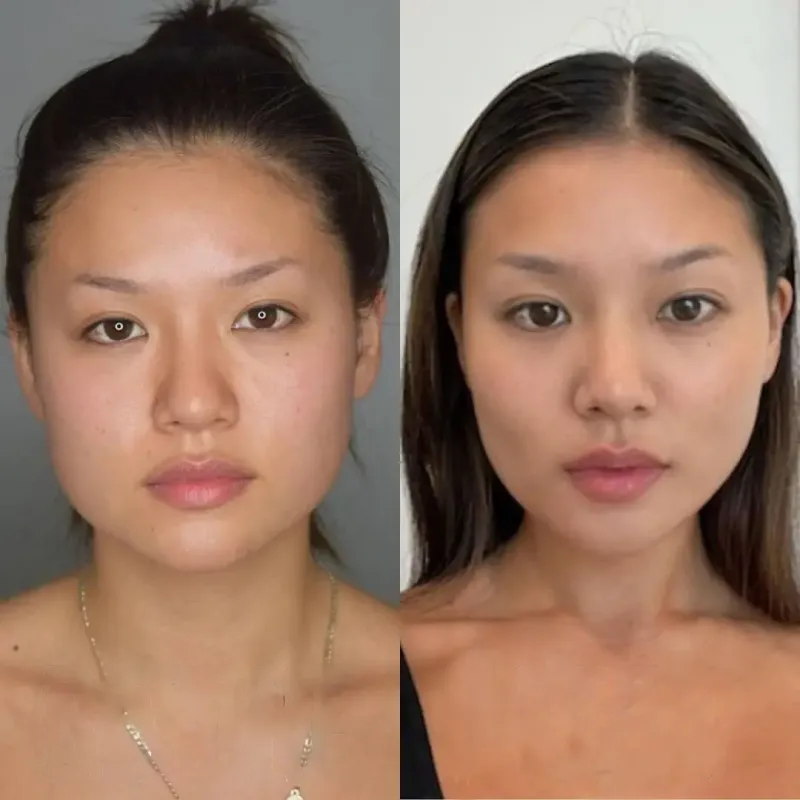 Before and after result of a female buccal fat removal