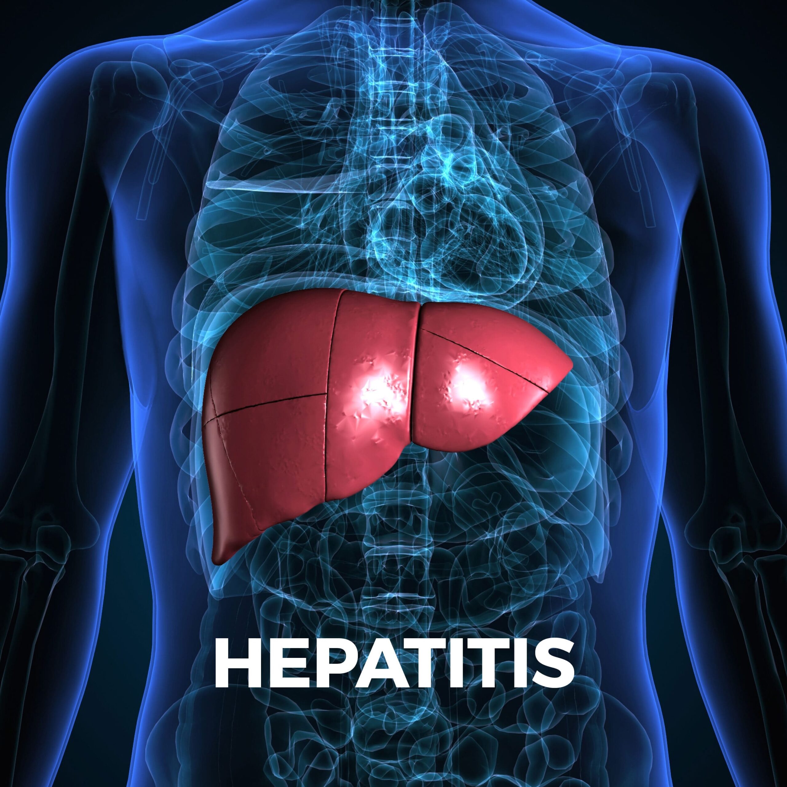 Hepatitis