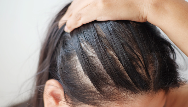 What are the major causes of hair loss? How can we prevent it?