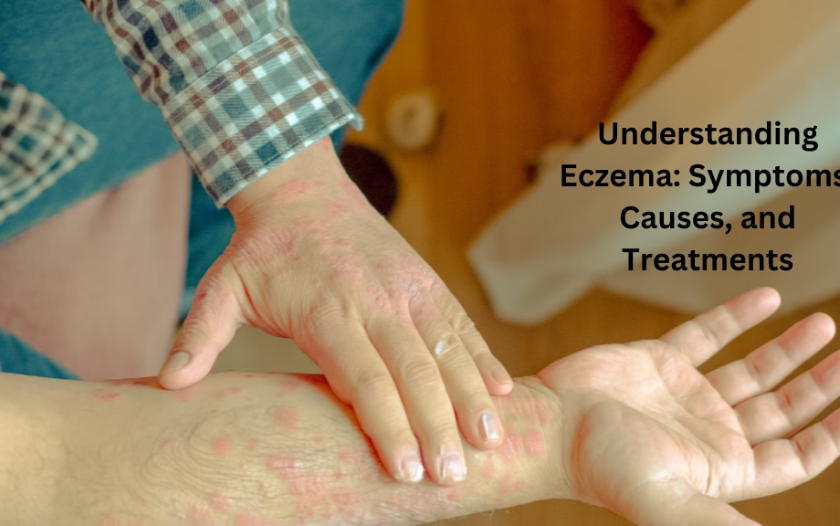 CBD for eczema