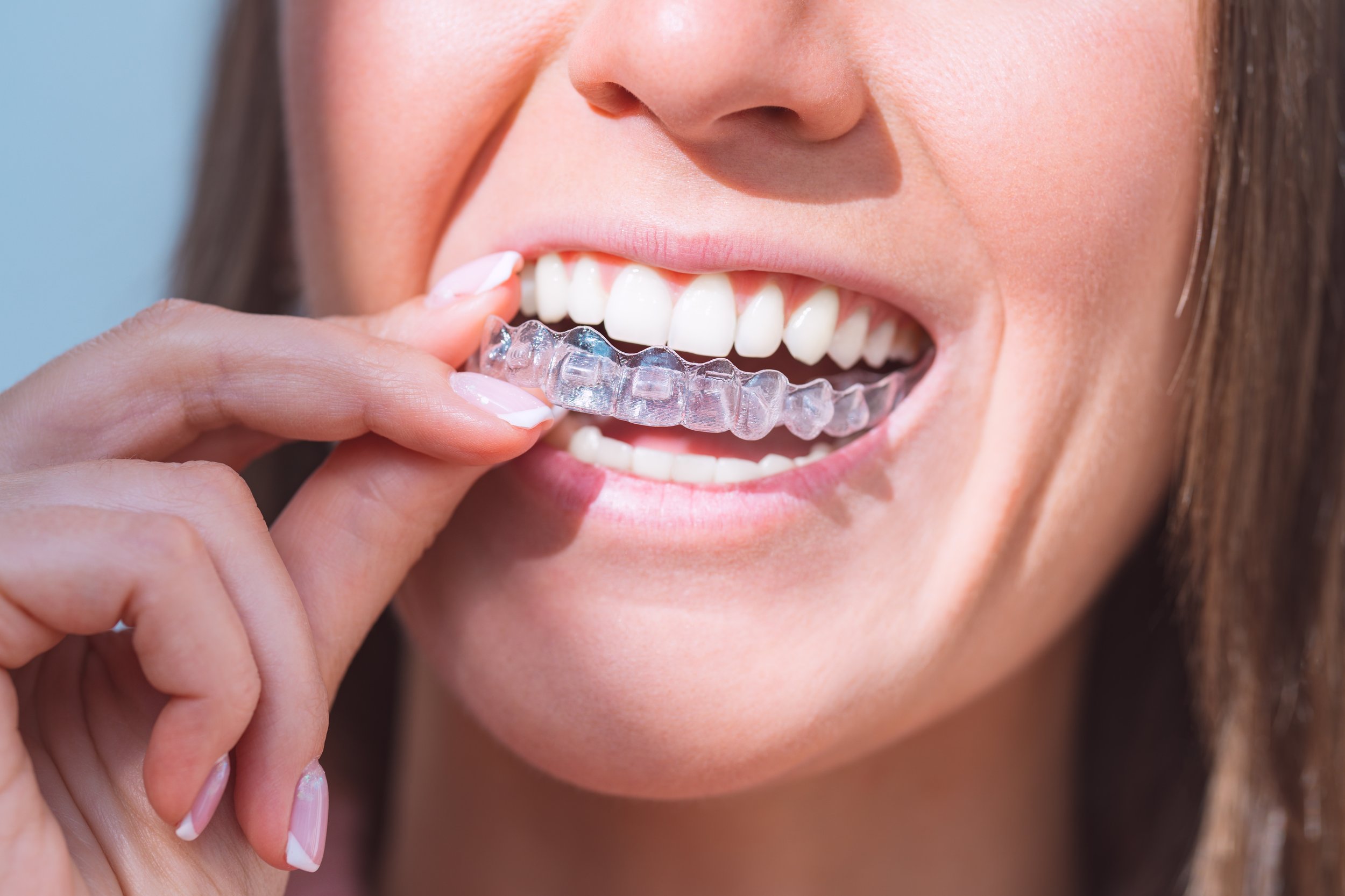 invisalign treatment