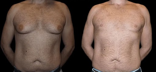 Tips for Maintaining Results Long-Term After Male Breast Reduction