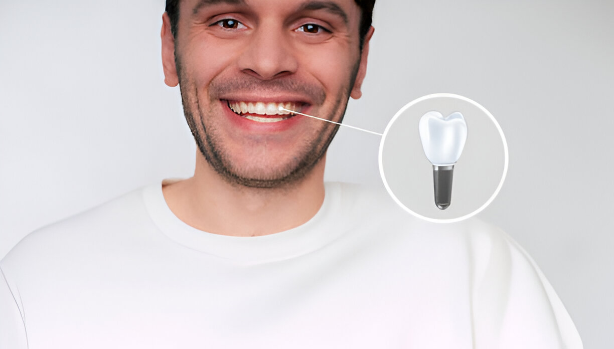 Dental Implants Aberdeen: Your Guide to a Brighter Smile