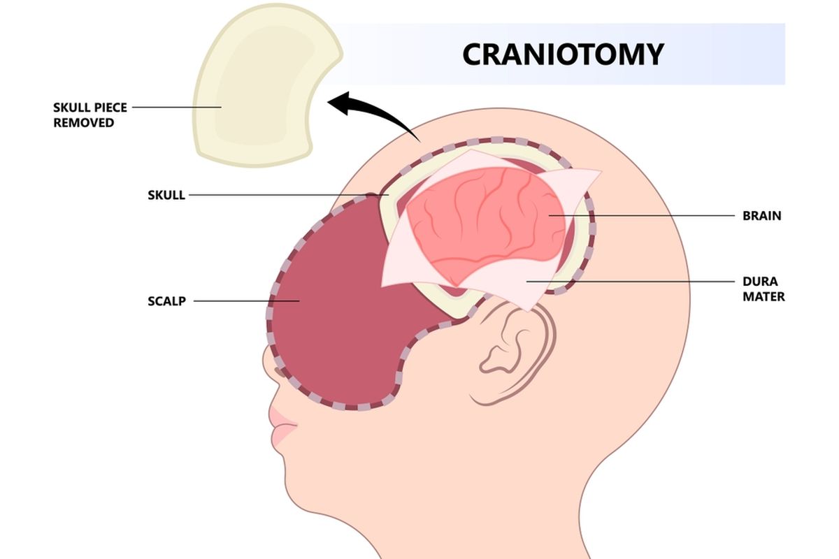 Cranioplasty