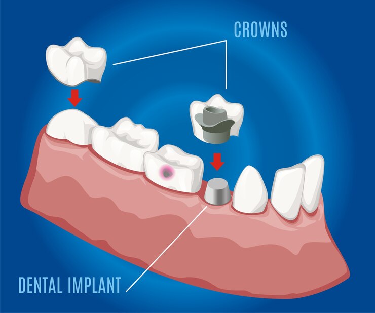 Why Do Dentists Use Dental Crowns Instead of Fillings?