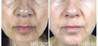 Aerolase Laser in Dubai: Transforming Skin Care